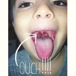 tonsillitis